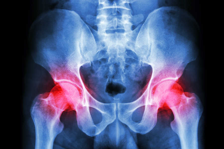¿Qué es el dolor en la cadera?