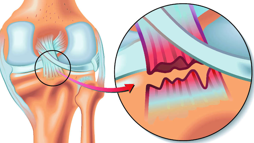 rotura completa del ligamento cruzado posterior de la rodilla