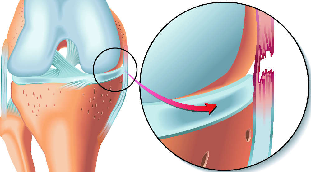 rotura parcial del ligamento lateral de la rodilla